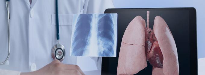 El equipo de radiología analiza la radiografía de tórax junto con la visualización pulmonar en 3D para obtener información diagnóstica
